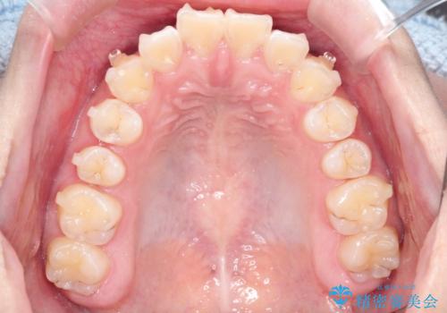 インビザラインによる出っ歯の非抜歯矯正の治療中