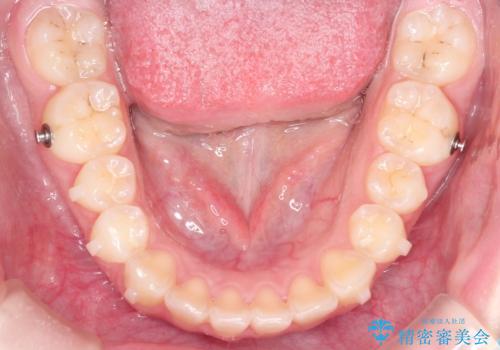 インビザラインによる出っ歯の非抜歯矯正の治療中