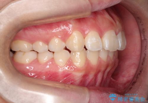 インビザラインによる出っ歯の非抜歯矯正の治療後