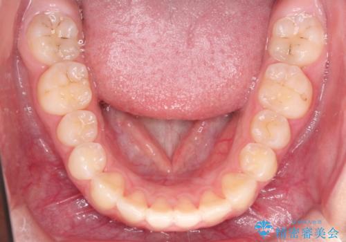 インビザラインによる出っ歯の非抜歯矯正の治療後