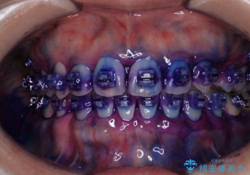 ワイヤー矯正中に歯の染め出しの治療前