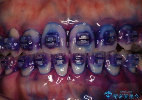ワイヤー矯正中に歯の染め出しの治療前