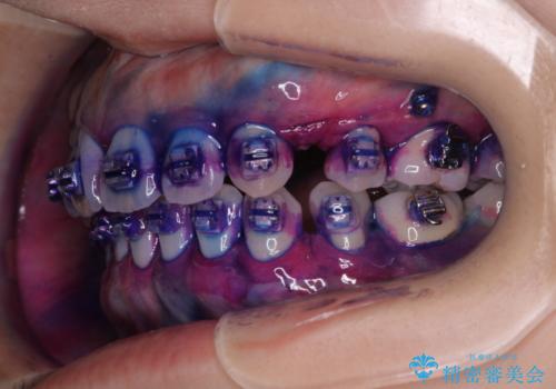 ワイヤー矯正中に歯の染め出しの治療前