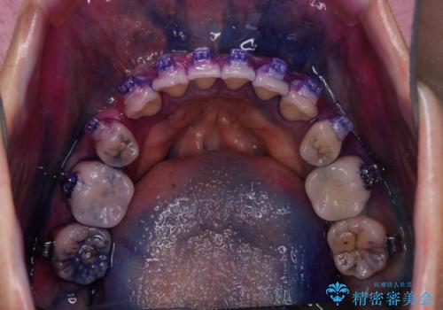 ワイヤー矯正中に歯の染め出しの治療前