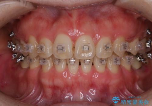 ワイヤー矯正中に歯の染め出しの治療後