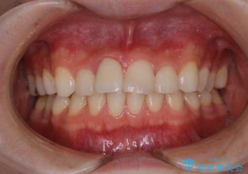 歯周病・虫歯・口臭などのトータルケア　PMTCの治療前
