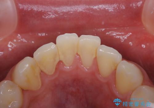 歯周病・虫歯・口臭などのトータルケア　PMTCの症例 治療前