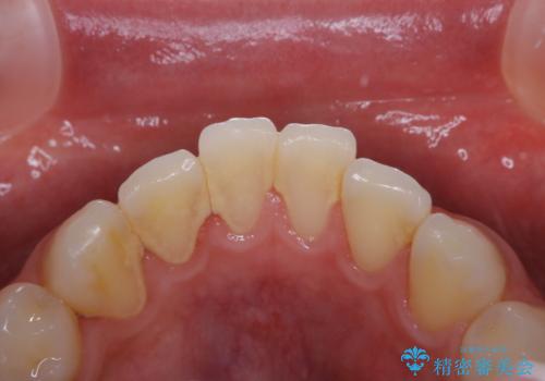 歯周病・虫歯・口臭などのトータルケア　PMTCの治療前
