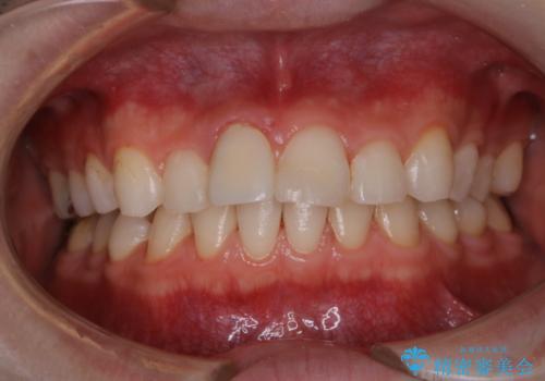 歯周病・虫歯・口臭などのトータルケア　PMTCの治療後