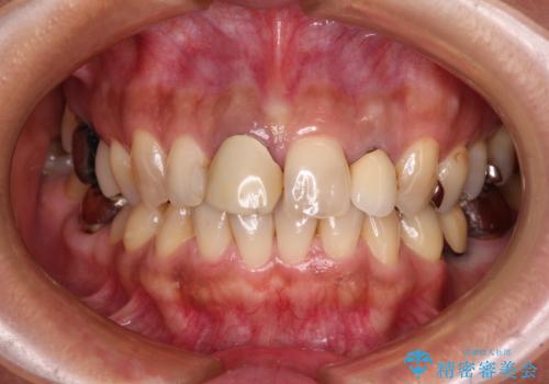 変色した保険クラウンをきれいに オールセラミッククラウンによる補綴治療の治療前