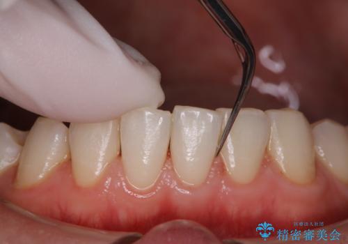 歯周病・虫歯・口臭などのトータルケア　PMTC