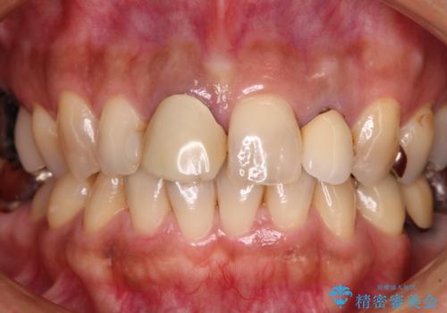 変色した保険クラウンをきれいに オールセラミッククラウンによる補綴治療の治療前