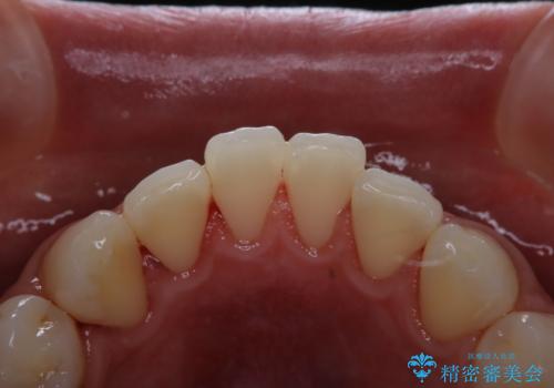 歯周病・虫歯・口臭などのトータルケア　PMTCの症例 治療後
