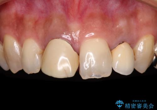変色した保険クラウンをきれいに オールセラミッククラウンによる補綴治療の症例 治療前