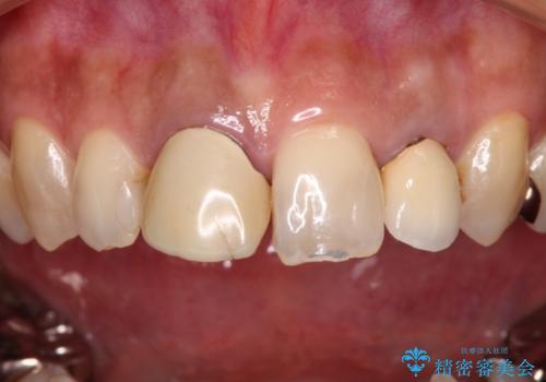 変色した保険クラウンをきれいに オールセラミッククラウンによる補綴治療の治療前