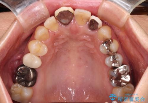 変色した保険クラウンをきれいに オールセラミッククラウンによる補綴治療の治療前