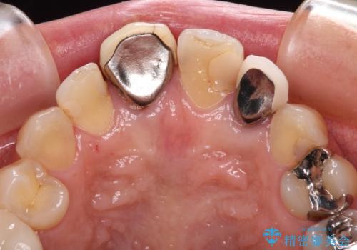 変色した保険クラウンをきれいに オールセラミッククラウンによる補綴治療の治療前