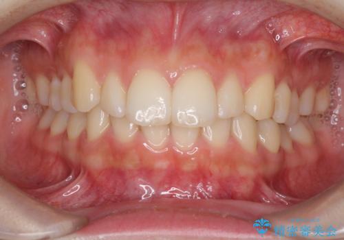 インビザラインを断念 ワイヤー装置で楽々と矯正治療の症例 治療前