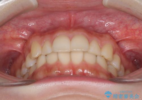 インビザラインを断念 ワイヤー装置で楽々と矯正治療の治療前