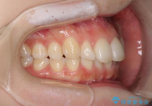 インビザラインを断念 ワイヤー装置で楽々と矯正治療の治療前