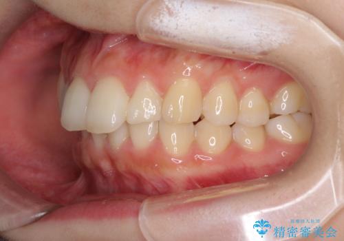 インビザラインを断念 ワイヤー装置で楽々と矯正治療の治療前