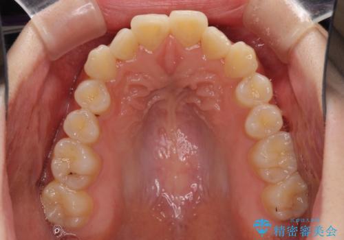 インビザラインを断念 ワイヤー装置で楽々と矯正治療の治療前