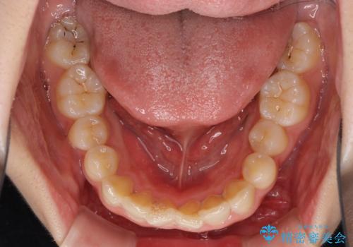 インビザラインを断念 ワイヤー装置で楽々と矯正治療の治療前