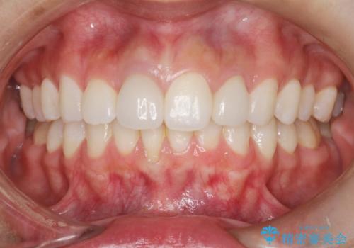 後戻りした歯並びをきれいにしたい