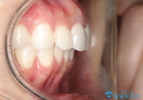 後戻りした歯並びをきれいにしたいの治療後