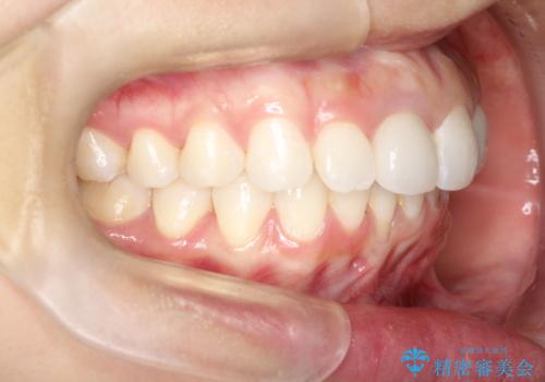 後戻りした歯並びをきれいにしたいの治療後