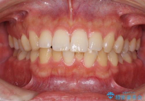 前歯のデコボコと突出感　インビザラインにて矯正治療の症例 治療前