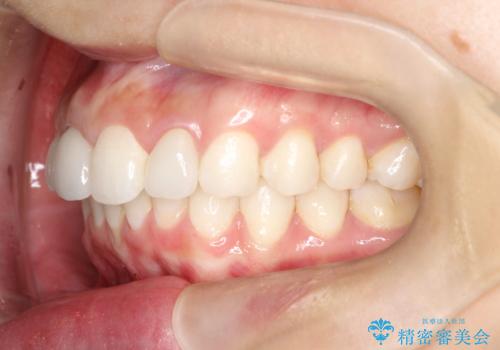 後戻りした歯並びをきれいにしたいの治療後