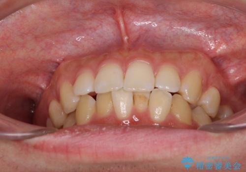 前歯のデコボコと突出感 インビザラインにて矯正治療の治療前