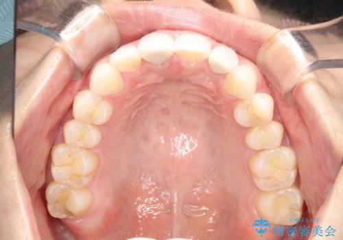 後戻りした歯並びをきれいにしたいの治療後