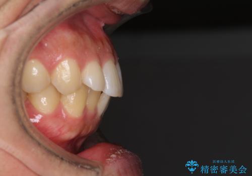 前歯のデコボコと突出感 インビザラインにて矯正治療の治療前