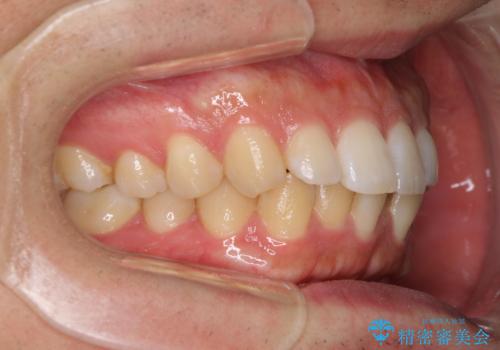前歯のデコボコと突出感 インビザラインにて矯正治療の治療前