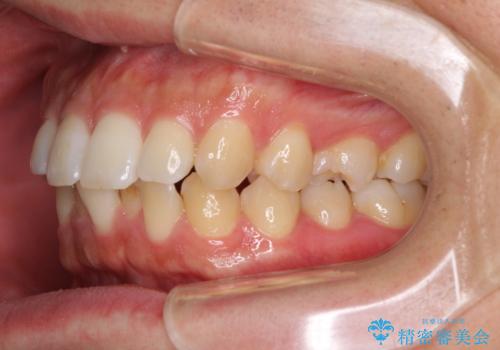 前歯のデコボコと突出感 インビザラインにて矯正治療の治療前