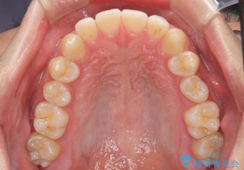 前歯のデコボコと突出感 インビザラインにて矯正治療の治療前