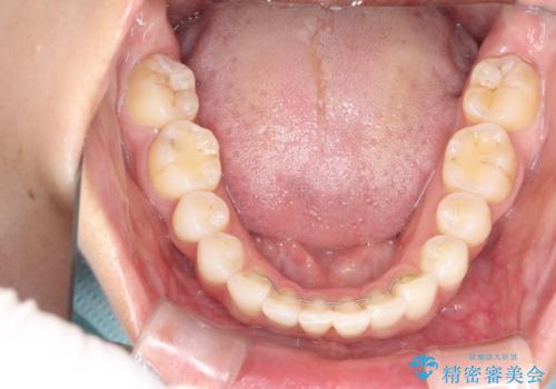 後戻りした歯並びをきれいにしたいの治療後