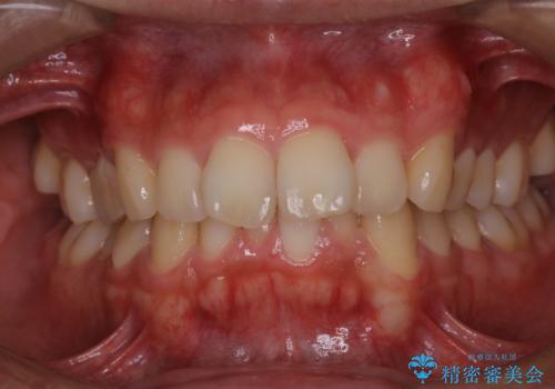 虫歯ではなく、歯の着色の治療前