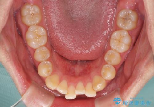 前歯のデコボコと突出感 インビザラインにて矯正治療の治療前