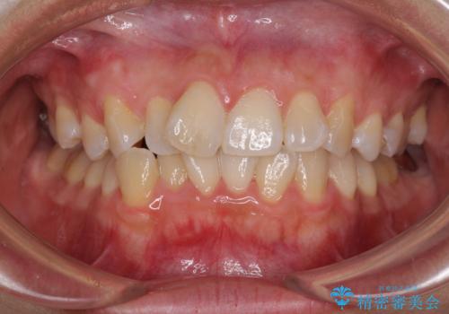 前歯のデコボコをインビザラインでスッキリと仕上げるの治療前