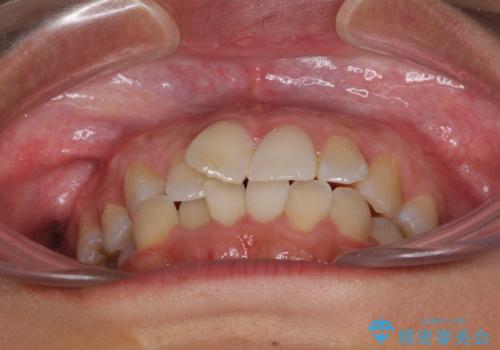 前歯のデコボコをインビザラインでスッキリと仕上げるの治療前