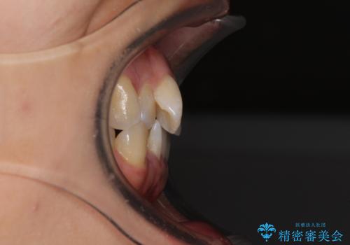 前歯のデコボコをインビザラインでスッキリと仕上げるの治療前