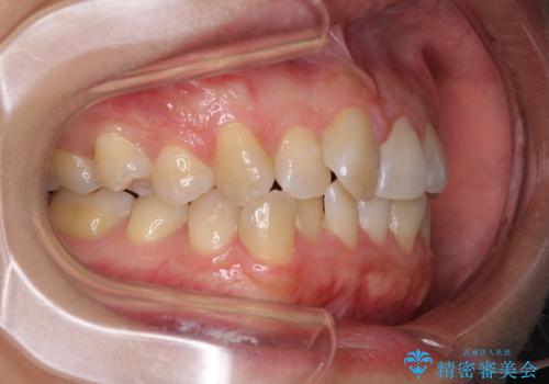 前歯のデコボコをインビザラインでスッキリと仕上げるの治療前