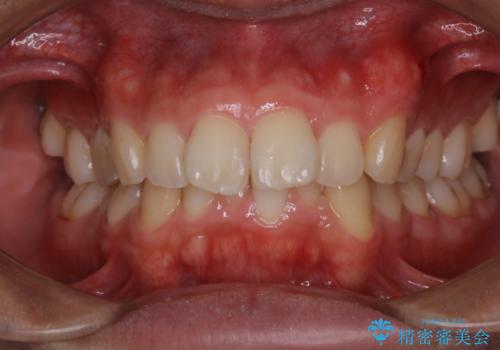 虫歯ではなく、歯の着色の治療後
