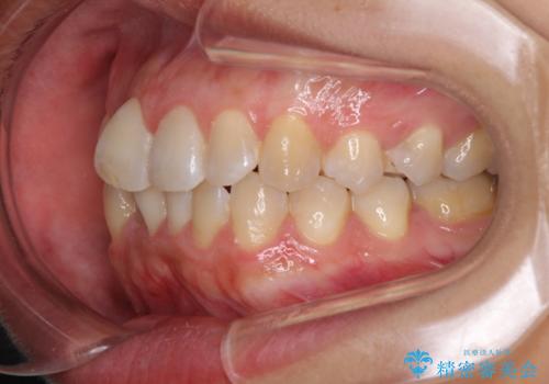 前歯のデコボコをインビザラインでスッキリと仕上げるの治療前