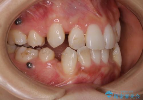 20代女性 インビザラインでのマウスピース矯正中にPMTCできれいな口元にの治療前