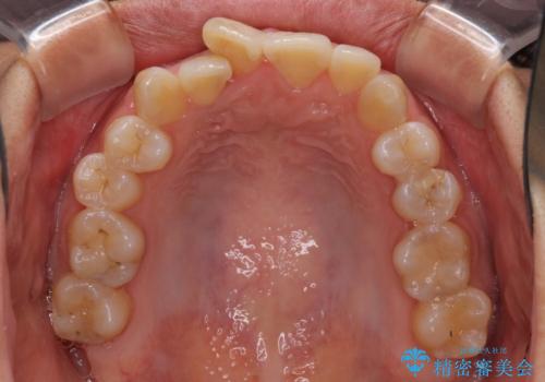 前歯のデコボコをインビザラインでスッキリと仕上げるの治療前