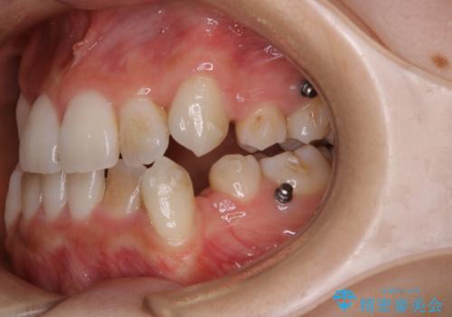 20代女性 インビザラインでのマウスピース矯正中にPMTCできれいな口元にの治療前
